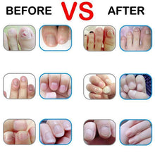Load image into Gallery viewer, Herbal Nail Fungus Treatment Pen